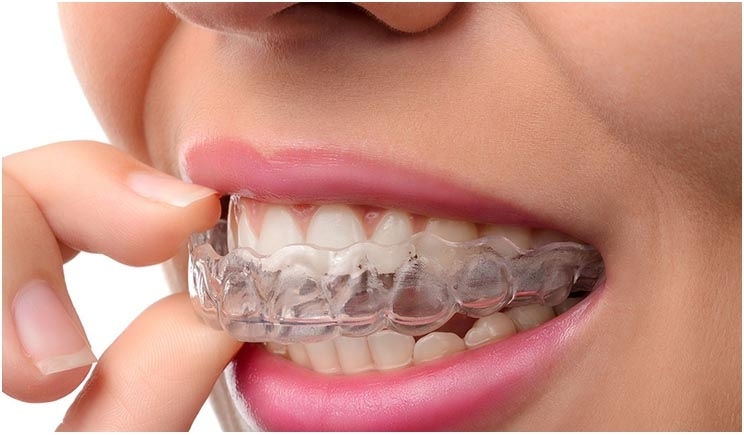 Invisalign-Invisible-Braces-in-Bangalore