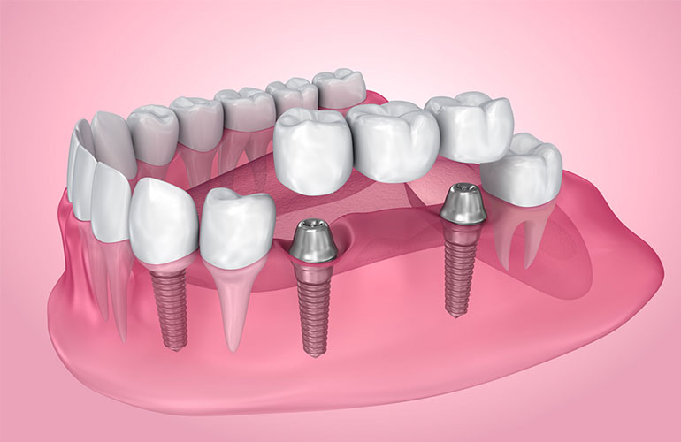 crowns-bridges-onlays