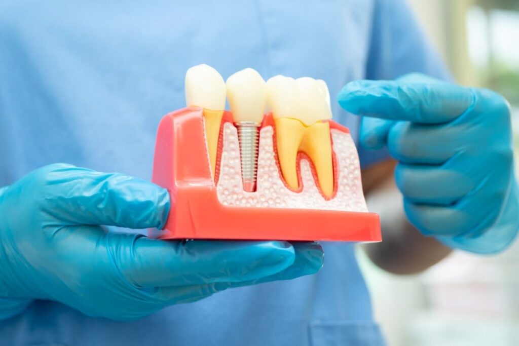 denta implant care