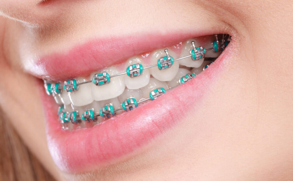 rubber-bands-for-braces-scaled-1